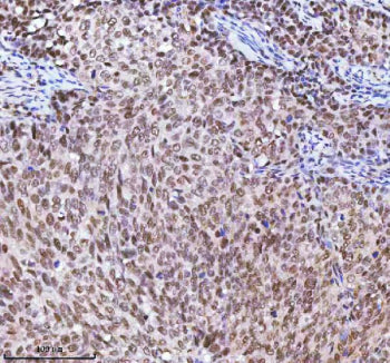 Immunohistochemical staining of RBM42 using anti-RBM42 antibody. RBM42 was detected in a paraffin-embedded section of human prostate adenocarcinoma tissue. Heat mediated antigen retrieval was performed in EDTA buffer (pH 8.0, epitope retrieval solution). The tissue section was blocked with 10% goat serum. The tissue section was then incubated with 2 ug/ml rabbit anti-RBM42 antibody overnight at 4oC. Peroxidase Conjugated Goat Anti-rabbit IgG was used as secondary antibody and incubated for 30 min at 37oC.