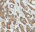 Immunohistochemical staining of MAPK14 using anti- MAPK14 antibody. MAPK14 was detected in a paraffin-embedded section of human breast cancer tissue. Heat mediated antigen retrieval was performed in EDTA buffer (pH 8.0, epitope retrieval solution). The tissue section was blocked with 10% goat serum. The tissue section was then incubated with 2 ug/ml rabbit anti- MAPK14 antibody overnight at 4oC. Peroxidase Conjugated Goat Anti-rabbit IgG was used as secondary antibody and incubated for 30 min at 37oC.