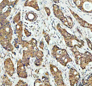 Immunohistochemical staining of MAPK14 using anti- MAPK14 antibody. MAPK14 was detected in a paraffin-embedded section of human breast cancer tissue. Heat mediated antigen retrieval was performed in EDTA buffer (pH 8.0, epitope retrieval solution). The tissue section was blocked with 10% goat serum. The tissue section was then incubated with 2 ug/ml rabbit anti- MAPK14 antibody overnight at 4oC. Peroxidase Conjugated Goat Anti-rabbit IgG was used as secondary antibody and incubated for 30 min at 37oC.