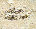 IHC analysis of FFPE human breast carcinoma with HER3 antibody