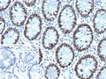 IHC staining of FFPE human colon tissue with recombinant GTBP antibody (clone MSH6/13194R). Inset: PBS used in place of primary Ab (secondary Ab negative control). HIER: boil tissue sections in pH 9 10mM Tris with 1mM EDTA for 20 min and allow to cool before testing.
