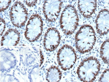 IHC staining of FFPE human colon tissue with recombinant GTBP antibody (clone MSH6/13194R). Inset: PBS used in place of primary Ab (secondary Ab negative control). HIER: boil tissue sections in pH 9 10mM Tris with 1mM EDTA for 20 min and allow to cool before testing.
