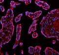 Immunofluorescent staining of ADAM12 using anti-ADAM12 antibody (red). ADAM12 was detected in a paraffin-embedded section of human endometrial cancer tissue. Heat mediated antigen retrieval was performed in EDTA buffer (pH 8.0, epitope retrieval solution). The tissue section was blocked with 10% goat serum. The tissue section was then incubated with 5 ug/ml rabbit anti-ADAM12 antibody overnight at 4oC.