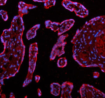 Immunofluorescent staining of ADAM12 using anti-ADAM12 antibody (red). ADAM12 was detected in a paraffin-embedded section of human endometrial cancer tissue. Heat mediated antigen retrieval was performed in EDTA buffer (pH 8.0, epitope retrieval solution). The tissue section was blocked with 10% goat serum. The tissue section was then incubated with 5 ug/ml rabbit anti-ADAM12 antibody overnight at 4oC.