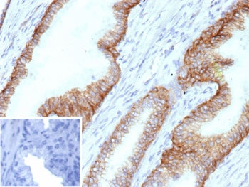 IHC staining of FFPE human prostate tissue with MOAT-B antibody (clone ABCC4/9178). Inset: PBS used in place of primary Ab (secondary Ab negative control). HIER: boil tissue sections in pH 9 10mM Tris with 1mM EDTA for 20 min and allow to cool before testing.
