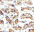 Immunohistochemical staining of SORL1 using anti-SORL1 antibody. SORL1 was detected in a paraffin-embedded section of human breast cancer tissue. Heat mediated antigen retrieval was performed in EDTA buffer (pH 8.0, epitope retrieval solution). The tissue section was blocked with 10% goat serum. The tissue section was then incubated with 2 ug/ml rabbit anti-SORL1 antibody overnight at 4oC. Peroxidase Conjugated Goat Anti-rabbit IgG was used as secondary antibody and incubated for 30 min at 37oC.