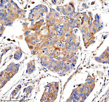 IHC analysis of PHLDB3 using anti-PHLDB3 antibody. PHLDB3 was detected in a paraffin-embedded section of human esophageal cancer tissue. Heat mediated antigen retrieval was performed in EDTA buffer (pH 8.0, epitope retrieval solution). The tissue section was blocked with 10% goat serum. The tissue section was then incubated with 2 ug/ml rabbit anti-PHLDB3 antibody overnight at 4oC. Peroxidase Conjugated Goat Anti-rabbit IgG was used as secondary antibody and incubated for 30 min at 37oC.