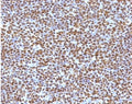 IHC testing of FFPE anaplastic large-cell lymphoma with ALK antibody (clone ATKR-1). HIER: boil tissue sections in pH6, 10mM citrate buffer, for 10-20 min followed by cooling at RT for 20 min.