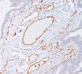 IHC staining of colon carcinoma with PECAM-1 antibody (clone C31.7). Note cell membrane staining of endothelial cells.
