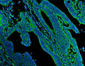 Immunofluorescent staining of FFPE human colon cancer with N-Cadherin antibody (green) and DAPI nuclear stain (blue). HIER: steam section in pH8 EDTA for 20 min.