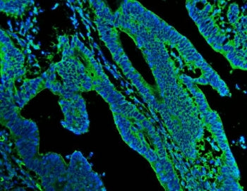 Immunofluorescent staining of FFPE human colon cancer with N-Cadherin antibody (green) and DAPI nuclear stain (blue). HIER: steam section in pH8 EDTA for 20 min.