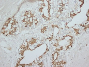 IHC staining of FFPE human breast cancer tissue with PKC alpha antibody. HIER: boil tissue sections in pH8 EDTA for 20 min and allow to cool before testing.