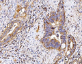 IHC staining of FFPE human gall bladder adenosquamous carcinoma tissue with P2X7 antibody. HIER: boil tissue sections in pH8 EDTA for 20 min and allow to cool before testing.
