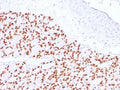 IHC testing of FFPE human thyroid with PAX8 antibody. Required HIER: boil tissue sections in 10mM Tris buffer with 1mM EDTA, pH 9, for 10-20 min and allow to cool before testing.