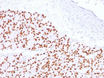 IHC testing of FFPE human thyroid with PAX8 antibody. Required HIER: boil tissue sections in 10mM Tris buffer with 1mM EDTA, pH 9, for 10-20 min and allow to cool before testing.