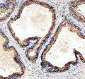 Immunohistochemical staining of TPD52 using anti-TPD52 antibody. TPD52 was detected in a paraffin-embedded section of human prostate cancer tissue. Heat mediated antigen retrieval was performed in EDTA buffer (pH 8.0, epitope retrieval solution). The tissue section was blocked with 10% goat serum. The tissue section was then incubated with 2 ug/ml rabbit anti-TPD52 antibody overnight at 4oC. Peroxidase Conjugated Goat Anti-rabbit IgG was used as secondary antibody and incubated for 30 min at 37oC.
