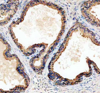 Immunohistochemical staining of TPD52 using anti-TPD52 antibody. TPD52 was detected in a paraffin-embedded section of human prostate cancer tissue. Heat mediated antigen retrieval was performed in EDTA buffer (pH 8.0, epitope retrieval solution). The tissue section was blocked with 10% goat serum. The tissue section was then incubated with 2 ug/ml rabbit anti-TPD52 antibody overnight at 4oC. Peroxidase Conjugated Goat Anti-rabbit IgG was used as secondary antibody and incubated for 30 min at 37oC.