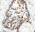 Immunohistochemical staining of UBE2W using anti-UBE2W antibody. UBE2W was detected in a paraffin-embedded section of human pancreas cancer tissue. Heat mediated antigen retrieval was performed in EDTA buffer (pH 8.0, epitope retrieval solution). The tissue section was blocked with 10% goat serum. The tissue section was then incubated with 2 ug/ml rabbit anti-UBE2W antibody overnight at 4oC. Peroxidase Conjugated Goat Anti-rabbit IgG was used as secondary antibody and incubated for 30 min at 37oC.