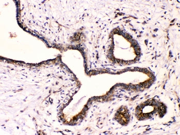 IHC testing of FFPE human breast cancer with Beta III Tubulin antibody at 1ug/ml. HIER: steam section in pH6 citrate buffer for 20 min.