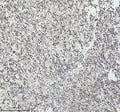 IHC analysis of GINS4 using anti-GINS4 antibody. GINS4 was detected in a paraffin-embedded section of human melanoma tissue. Heat mediated antigen retrieval was performed in EDTA buffer (pH 8.0, epitope retrieval solution). The tissue section was blocked with 10% goat serum. The tissue section was then incubated with 2 ug/ml rabbit anti-GINS4 antibody overnight at 4oC. Peroxidase Conjugated Goat Anti-rabbit IgG was used as secondary antibody and incubated for 30 min at 37oC.