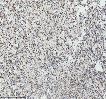 IHC analysis of GINS4 using anti-GINS4 antibody. GINS4 was detected in a paraffin-embedded section of human melanoma tissue. Heat mediated antigen retrieval was performed in EDTA buffer (pH 8.0, epitope retrieval solution). The tissue section was blocked with 10% goat serum. The tissue section was then incubated with 2 ug/ml rabbit anti-GINS4 antibody overnight at 4oC. Peroxidase Conjugated Goat Anti-rabbit IgG was used as secondary antibody and incubated for 30 min at 37oC.