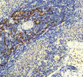 Immunohistochemical staining of GLIPR2 using anti-GLIPR2 antibody. GLIPR2 was detected in a paraffin-embedded section of human lung cancer tissue. Heat mediated antigen retrieval was performed in EDTA buffer (pH 8.0, epitope retrieval solution). The tissue section was blocked with 10% goat serum. The tissue section was then incubated with 2 ug/ml rabbit anti-GLIPR2 antibody overnight at 4oC. Peroxidase Conjugated Goat Anti-rabbit IgG was used as secondary antibody and incubated for 30 min at 37oC.