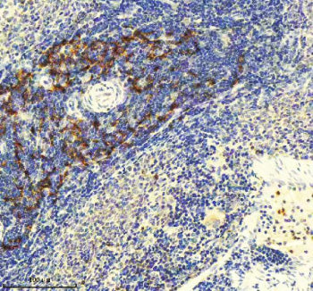 Immunohistochemical staining of GLIPR2 using anti-GLIPR2 antibody. GLIPR2 was detected in a paraffin-embedded section of human lung cancer tissue. Heat mediated antigen retrieval was performed in EDTA buffer (pH 8.0, epitope retrieval solution). The tissue section was blocked with 10% goat serum. The tissue section was then incubated with 2 ug/ml rabbit anti-GLIPR2 antibody overnight at 4oC. Peroxidase Conjugated Goat Anti-rabbit IgG was used as secondary antibody and incubated for 30 min at 37oC.