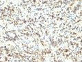 IHC staining of FFPE human Rhabdomyosarcoma with MyoD1 antibody (clone 5.8A). HIER: boil tissue sections in pH 9 10mM Tris with 1mM EDTA for 20 min and allow to cool before testing.