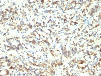 IHC staining of FFPE human Rhabdomyosarcoma with MyoD1 antibody (clone 5.8A). HIER: boil tissue sections in pH 9 10mM Tris with 1mM EDTA for 20 min and allow to cool before testing.