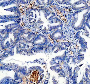 Immunohistochemical staining of TRIOBP using anti-TRIOBP antibody. TRIOBP was detected in a paraffin-embedded section of human colon cancer tissue. Heat mediated antigen retrieval was performed in EDTA buffer (pH 8.0, epitope retrieval solution). The tissue section was blocked with 10% goat serum. The tissue section was then incubated with 2 ug/ml rabbit anti-TRIOBP antibody overnight at 4oC. Peroxidase Conjugated Goat Anti-rabbit IgG was used as secondary antibody and incubated for 30 min at 37oC.