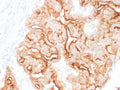 IHC staining of FFPE human ovarian carcinoma with MUC16 antibody. HIER: boil tissue sections in pH 9 10mM Tris with 1mM EDTA for 20 min and allow to cool before testing.