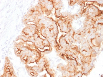 IHC staining of FFPE human ovarian carcinoma with MUC16 antibody. HIER: boil tissue sections in pH 9 10mM Tris with 1mM EDTA for 20 min and allow to cool before testing.