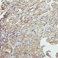 IHC staining of FFPE human stomach cancer with CETP antibody. HIER: boil tissue sections in pH6, 10mM citrate buffer, for 20 min and allow to cool before testing.