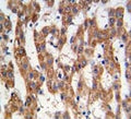 IHC analysis of FFPE human hepatocarcinoma tissue stained with PHB antibody