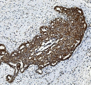 IHC staining of FFPE human breast cancer tissue with FGF2 antibody. HIER: boil tissue sections in pH8 EDTA for 20 min and allow to cool before testing.