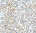 Immunohistochemical staining of GSTO1 using anti-GSTO1 antibody. GSTO1 was detected in a paraffin-embedded section of human liver cancer tissue. Heat mediated antigen retrieval was performed in EDTA buffer (pH 8.0, epitope retrieval solution). The tissue section was blocked with 10% goat serum. The tissue section was then incubated with 2 ug/ml rabbit anti-GSTO1 antibody overnight at 4oC. Peroxidase Conjugated Goat Anti-rabbit IgG was used as secondary antibody and incubated for 30 min at 37oC.