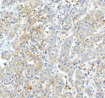 Immunohistochemical staining of GSTO1 using anti-GSTO1 antibody. GSTO1 was detected in a paraffin-embedded section of human liver cancer tissue. Heat mediated antigen retrieval was performed in EDTA buffer (pH 8.0, epitope retrieval solution). The tissue section was blocked with 10% goat serum. The tissue section was then incubated with 2 ug/ml rabbit anti-GSTO1 antibody overnight at 4oC. Peroxidase Conjugated Goat Anti-rabbit IgG was used as secondary antibody and incubated for 30 min at 37oC.