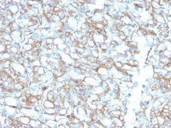 IHC testing of FFPE lung carcinoma with biotin-conjugated PD-L1 antibody (clone PDL1/2746). HIER: boil tissue sections in pH 9 10mM Tris with 1mM EDTA for 10-20 min followed by cooling at RT for 20 min.