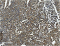 IHC staining of FFPE human lung cancer with CLTC antibody. HIER: boil tissue sections in pH8 EDTA for 20 min and allow to cool before testing.