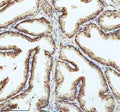 IHC staining of FFPE human prostate cancer tissue with PIN4 antibody. HIER: boil tissue sections in pH8 EDTA for 20 min and allow to cool before testing.