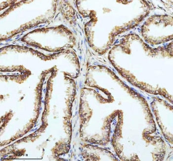IHC staining of FFPE human prostate cancer tissue with PIN4 antibody. HIER: boil tissue sections in pH8 EDTA for 20 min and allow to cool before testing.