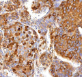 IHC staining of FFPE human liver cancer tissue with HSD17B13 antibody. HIER: boil tissue sections in pH8 EDTA for 20 min and allow to cool before testing.