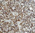 Immunohistochemical staining of DCTPP1 using anti-DCTPP1 antibody. DCTPP1 was detected in a paraffin-embedded section of human breast cancer tissue. Heat mediated antigen retrieval was performed in EDTA buffer (pH 8.0, epitope retrieval solution). The tissue section was blocked with 10% goat serum. The tissue section was then incubated with 2 ug/ml rabbit anti-DCTPP1 antibody overnight at 4oC. Peroxidase Conjugated Goat Anti-rabbit IgG was used as secondary antibody and incubated for 30 min at 37oC.