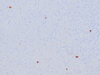 IHC staining of FFPE human HSV-infected tissue with Herpes Simplex Virus Type I antibody (clone HSVI/8375R). HIER: boil tissue sections in pH 9 10mM Tris with 1mM EDTA for 20 min and allow to cool before testing.