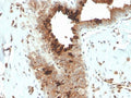 IHC staining of FFPE human breast carcinoma with recombinant Mammaglobin antibody (clone MGB/4057R). HIER: boil tissue sections in pH 9 10mM Tris with 1mM EDTA for 20 min and allow to cool before testing.