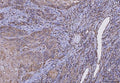 IHC staining of FFPE human laryngeal squamous cell carcinoma tissue with HLA-DRA antibody. HIER: boil tissue sections in pH8 EDTA for 20 min and allow to cool before testing.