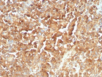 IHC staining of FFPE human melanoma tissue with recombinant NGFR antibody (clone rNGFR/8824). HIER: boil tissue sections in pH 9 10mM Tris with 1mM EDTA for 20 min and allow to cool before testing.