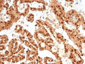 IHC staining of FFPE human renal cell carcinoma tissue with recombinant STAT6 antibody (clone STAT6/7163R). HIER: boil tissue sections in pH 9 10mM Tris with 1mM EDTA for 20 min and allow to cool before testing.