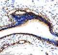 Immunohistochemical staining of NDUFS3 using anti-NDUFS3 antibody. NDUFS3 was detected in a paraffin-embedded section of human ovarian cancer tissue. Heat mediated antigen retrieval was performed in EDTA buffer (pH 8.0, epitope retrieval solution). The tissue section was blocked with 10% goat serum. The tissue section was then incubated with 2 ug/ml rabbit anti-NDUFS3 antibody overnight at 4oC. Peroxidase Conjugated Goat Anti-rabbit IgG was used as secondary antibody and incubated for 30 min at 37oC.