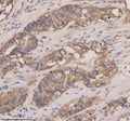 Immunohistochemical staining of CXCL13 using anti-CXCL13 antibody. CXCL13 was detected in a paraffin-embedded section of human appendiceal adenocarcinoma tissue. Heat mediated antigen retrieval was performed in EDTA buffer (pH 8.0, epitope retrieval solution). The tissue section was blocked with 10% goat serum. The tissue section was then incubated with 2 ug/ml rabbit anti-CXCL13 antibody overnight at 4oC.